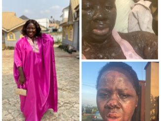 Nigerian burn survivor shares new photos months after a gas explosion nearly left her blind