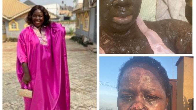 Nigerian burn survivor shares new photos months after a gas explosion nearly left her blind